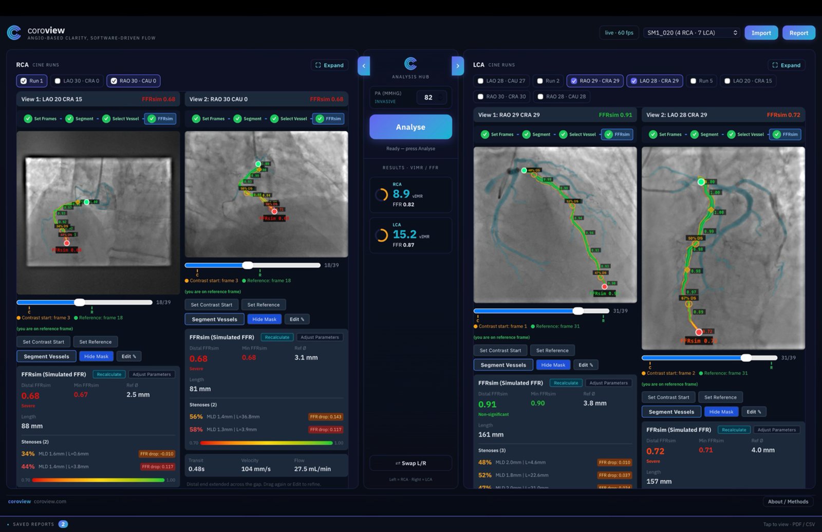 Coroview analysis hub with simultaneous RCA and LCA cine runs, FFRsim and vIMR results